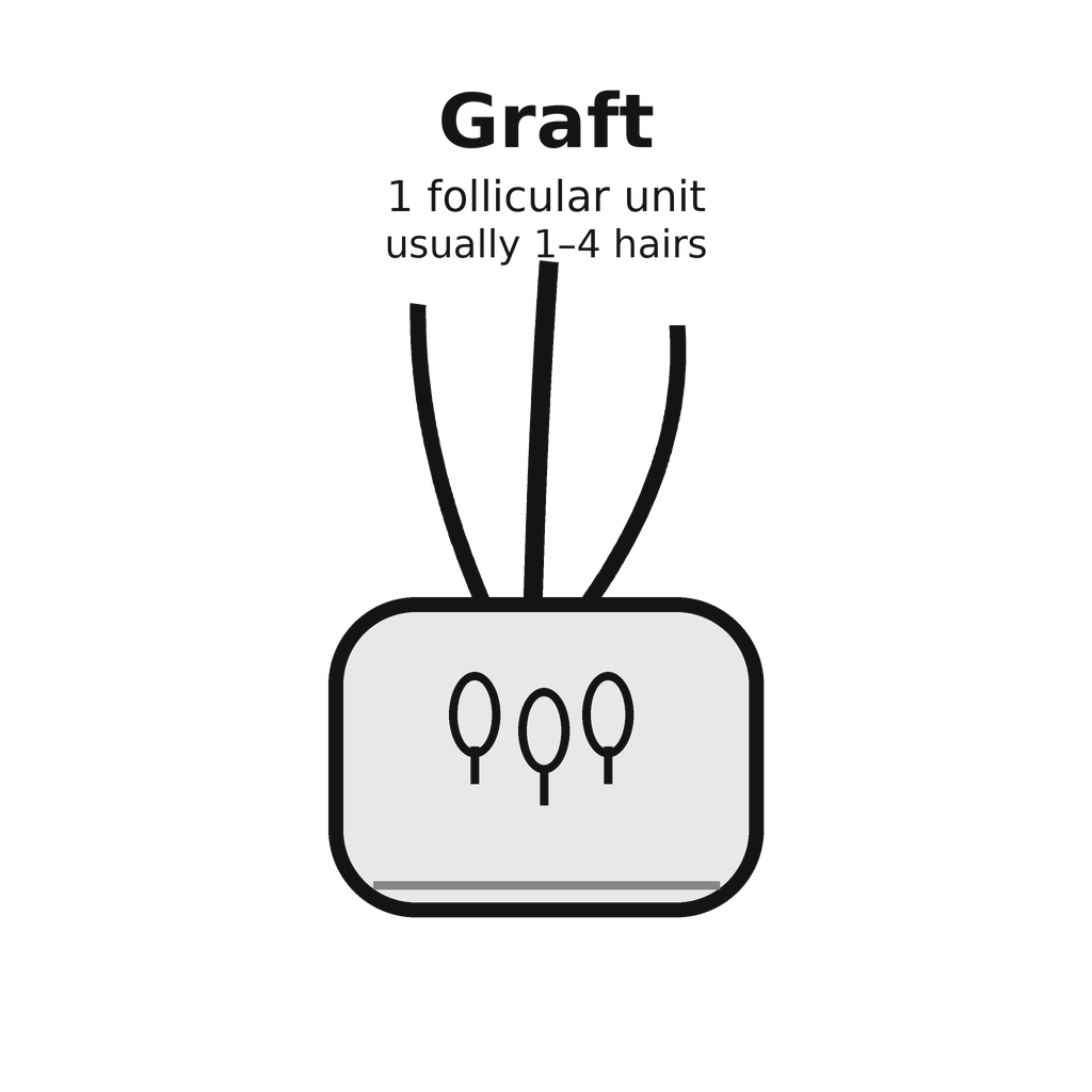 Illustration showing a follicular-unit graft