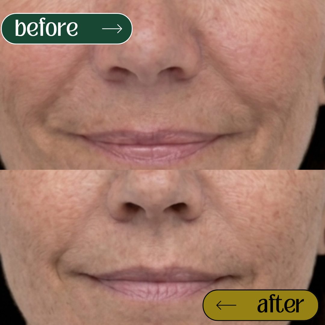 40-60 year old woman showing soft, natural smile lines and excellent mid-face structural harmony