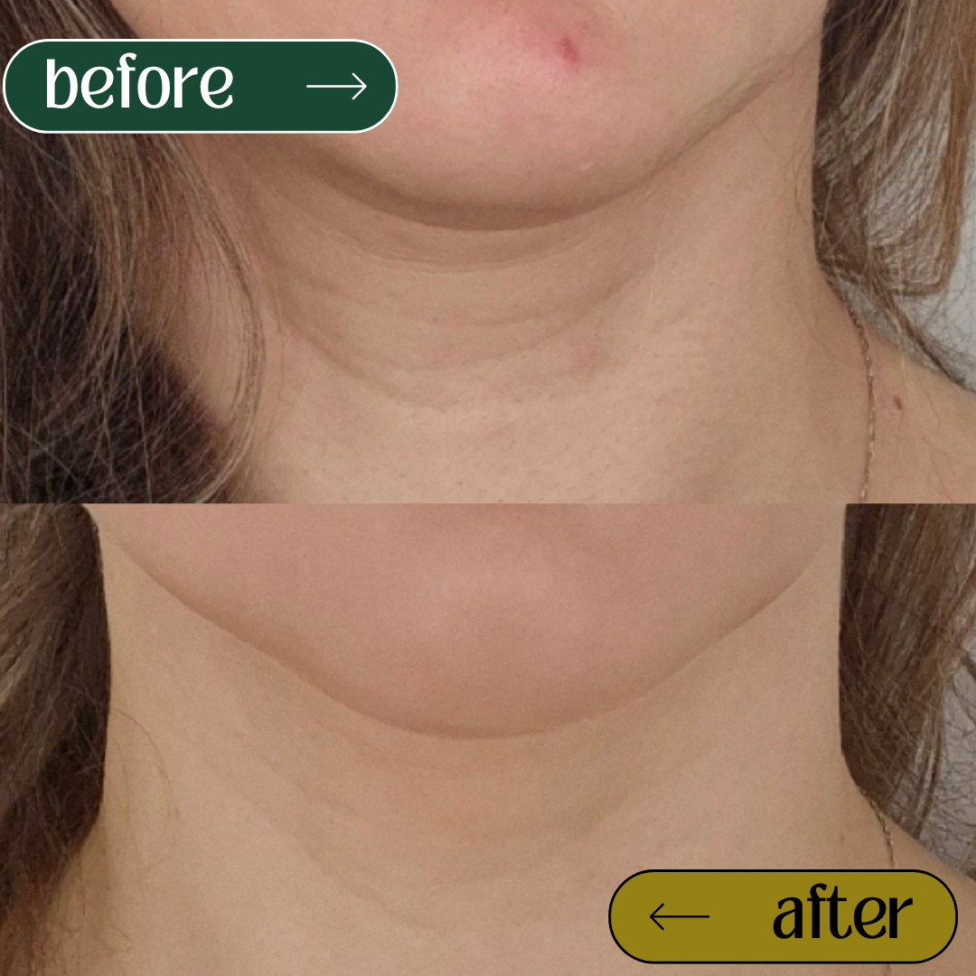 Nefertiti Neck Lift clinical profile view at Emerald Aesthetic Dublin